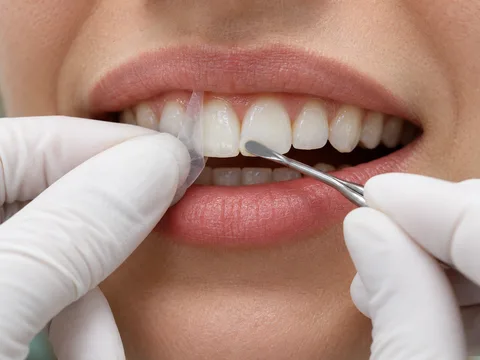 Precyzyjne modelowanie krawędzi przedniego zęba materiałem kompozytowym